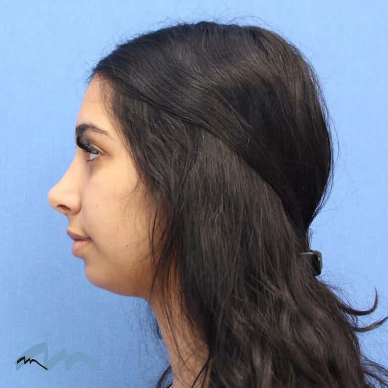 Rhinoplasty patient, profile view, after