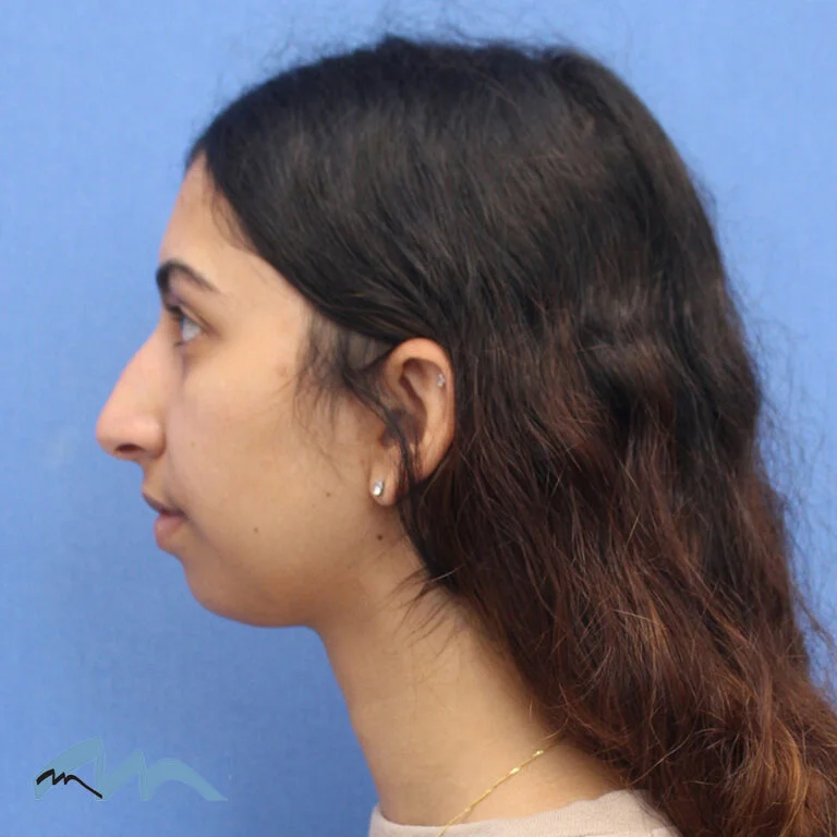 Rhinoplasty patient, profile view, before