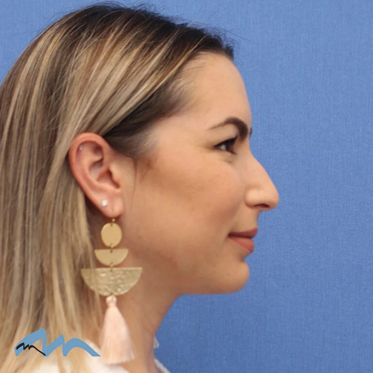 Rhinoplasty patient, front view, before