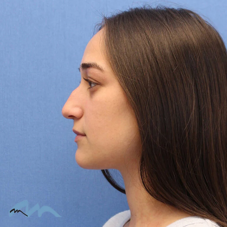 Rhinoplasty patient, front view, before